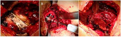 Conversion of a Fused or Ankylosed Hip to Total Hip Arthroplasty: Is the Direct Anterior Approach in the <mark class="highlighted">Lateral Decubitus</mark> Position an Ideal Solution?